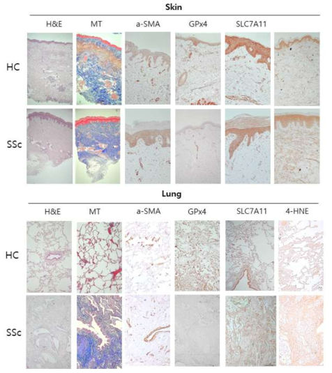 정상인과 전신경화증 환자의 피부와 폐조직에서 ferroptosis 신호관련 물질들의 활성 비교