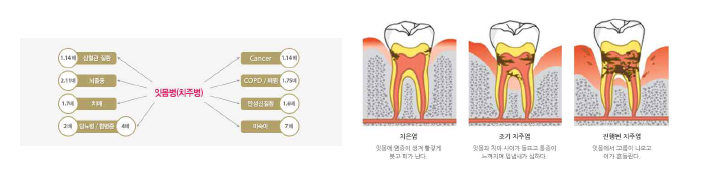 치주질환 관련 합병증 및 발생 과정 출처: https://conceptinfo.tistory.com/387